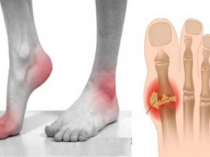 Gout